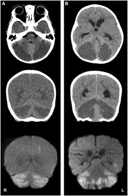 Malignant Cerebellar Edema Subsequent to Accidental Prescription Opioid Intoxication in Children